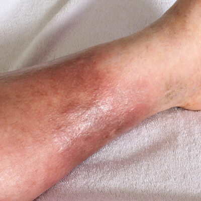 4 Natural Treatments for DVT