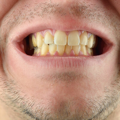 4 Natural Ways to Get Rid of Stains and Yellow Teeth