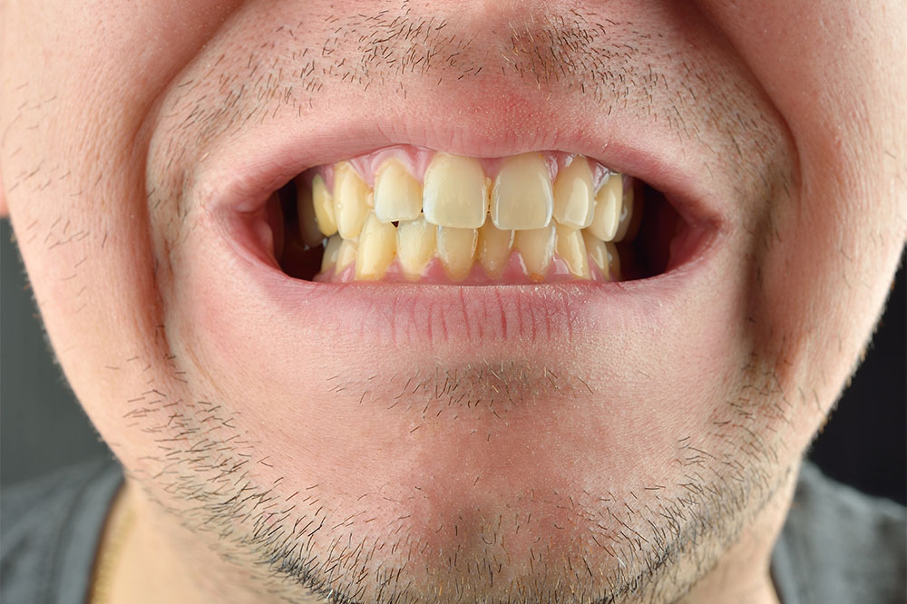 4 Natural Ways to Get Rid of Stains and Yellow Teeth