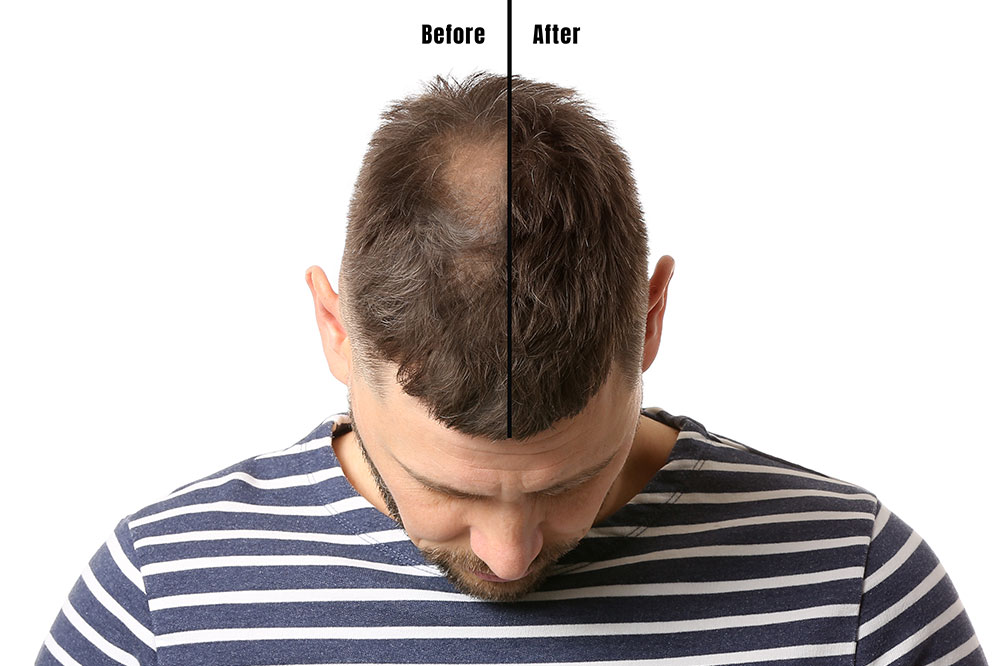 3 Hair Loss Treatments for Men