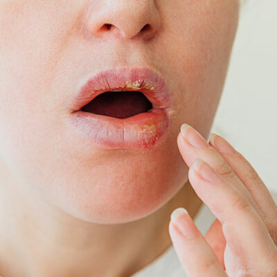 Cold Sores – Common Causes and Triggers
