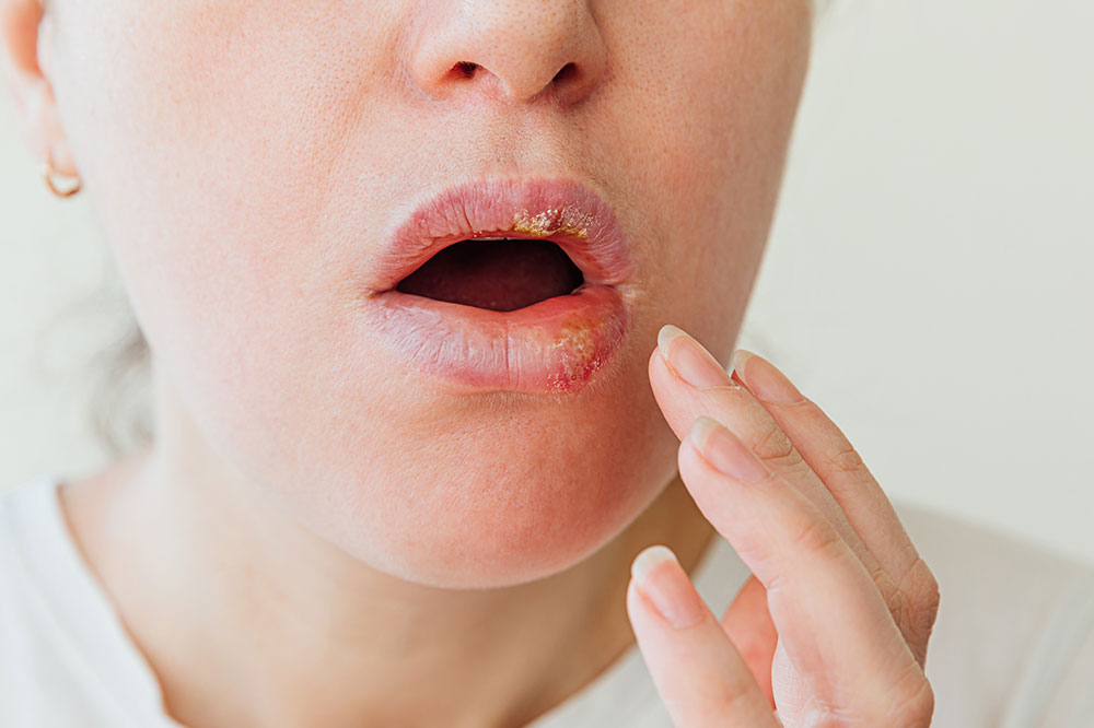 Cold Sores – Common Causes and Triggers