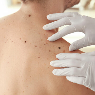 Melanoma – Types and Signs