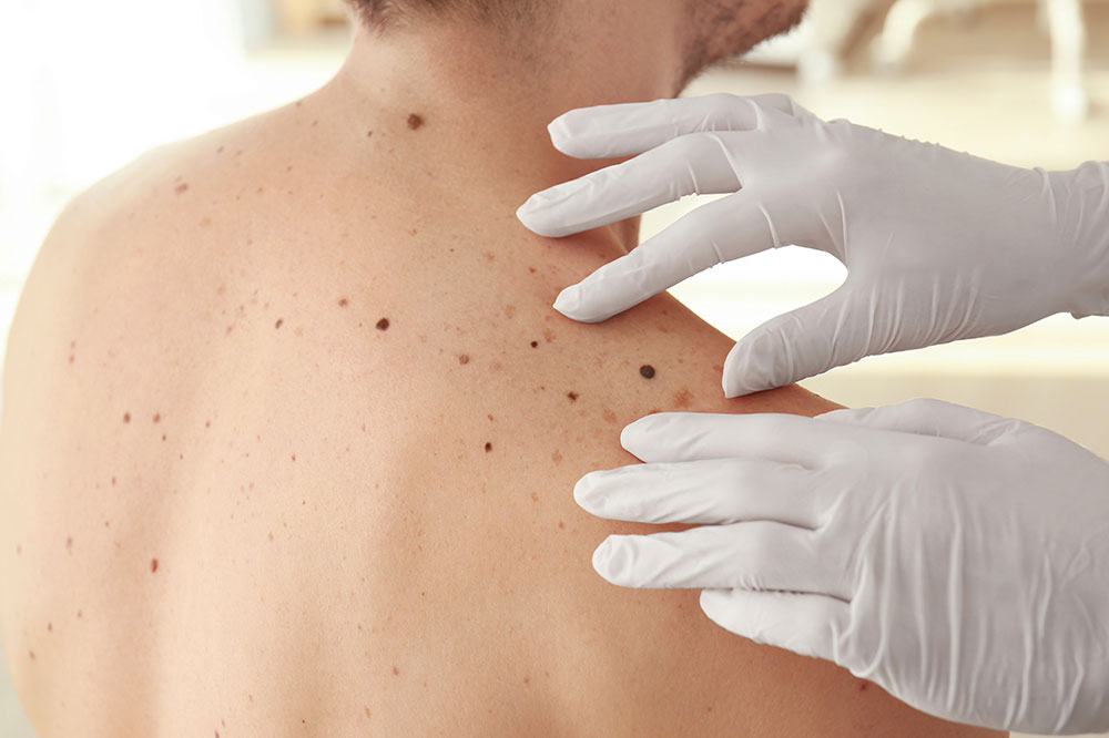 Melanoma – Types and Signs